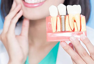 dental-implants