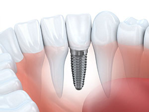 dental-implants