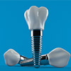 antalya-dental-implants