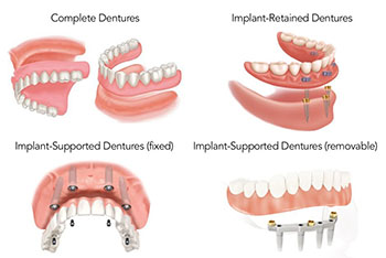 dentures-options