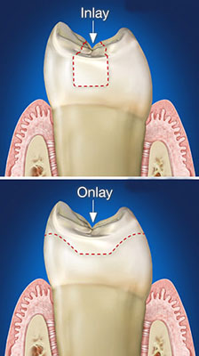 inlay-onlay