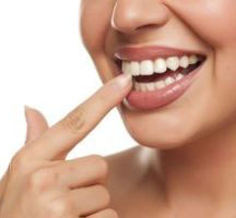 dental-veneers