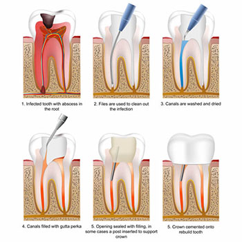 root-canal-therapy